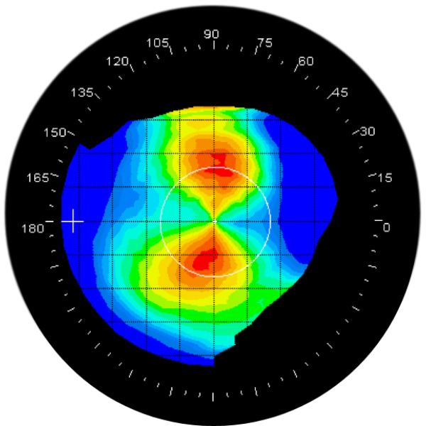 astigmatism topography