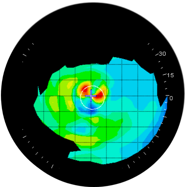 corneal distortion topography