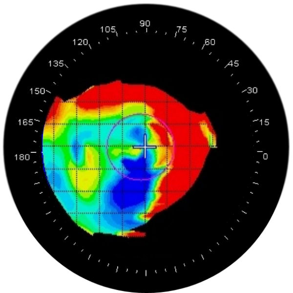 corneal graft topography