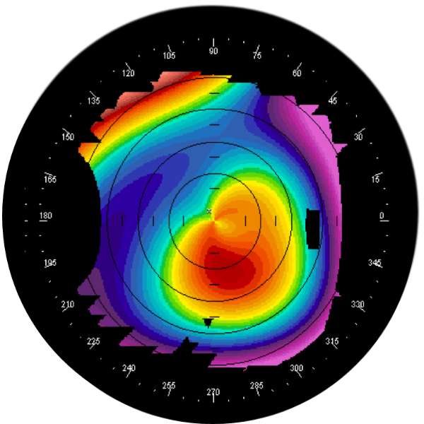 keratoconus corneal topography