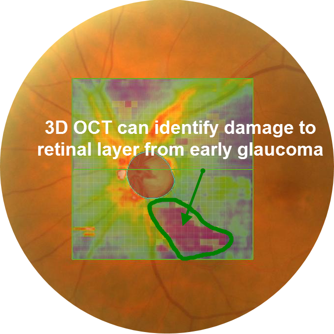 Glaucoma RNFL Analysis