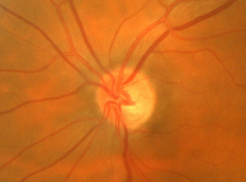 glaucoma optic nerve