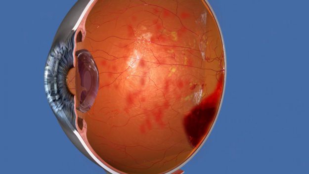 Proliferative Diabetic retinopathy