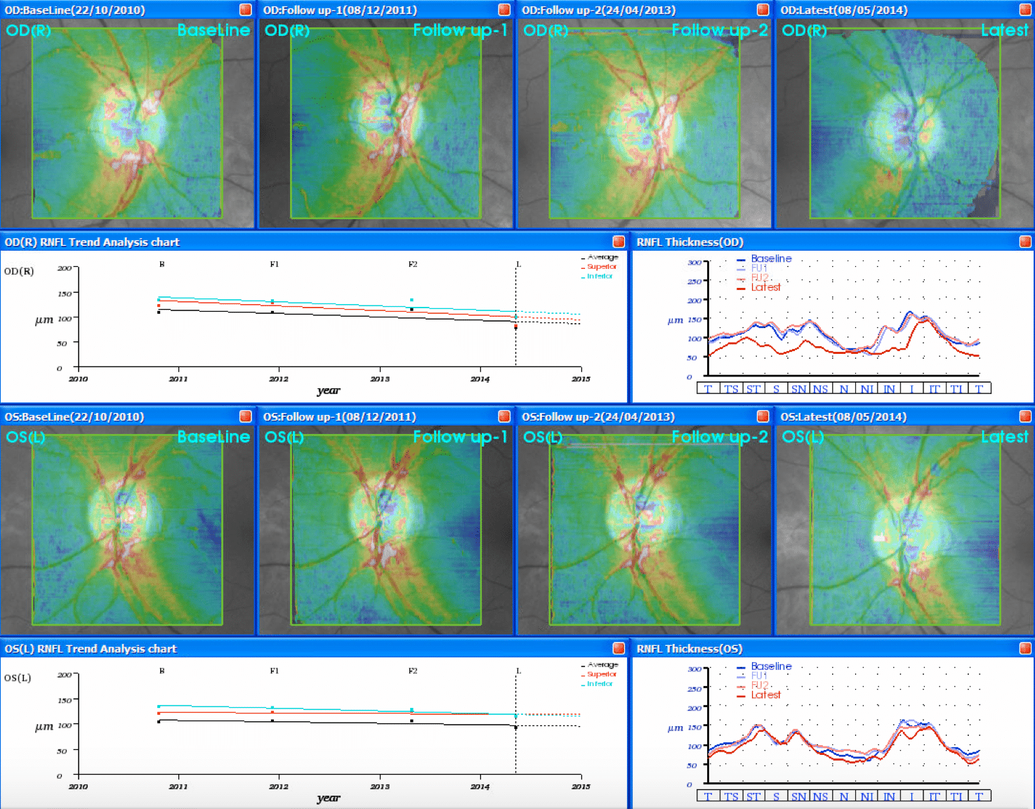 glaucoma monitoring