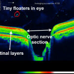 Optic nerve OCT