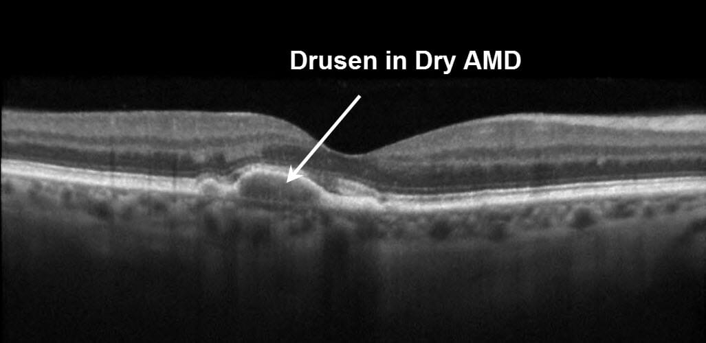 OCT scan showing Dry AMD  EYETECH