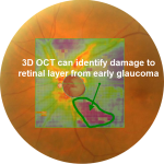 Glaucoma RNFL Analysis