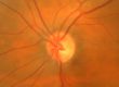 glaucoma optic nerve