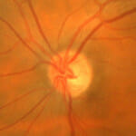 glaucoma optic nerve