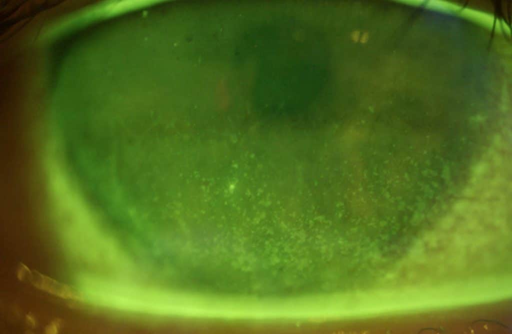 dry eye staining dry eye