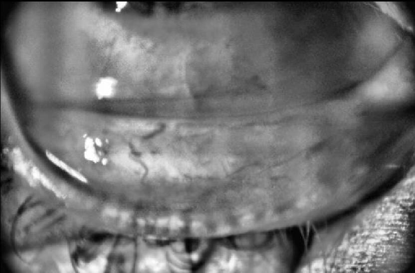 dry eye treatment coventry