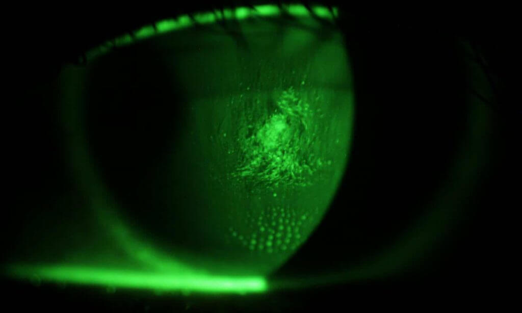 keratoconus staining